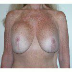 Breast Lift 09 Before Photo - 7