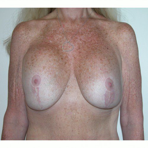 Breast Lift 09 Before Photo 