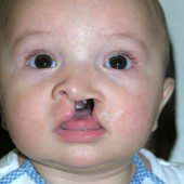 Cleft Lip 2