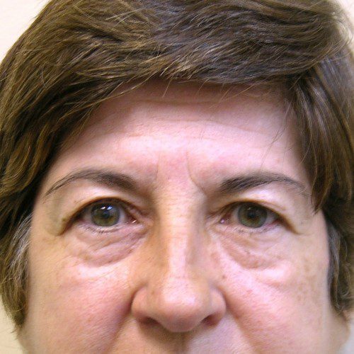 Browlift 15 Before Photo 