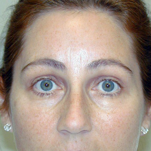 Browlift 12 After Photo