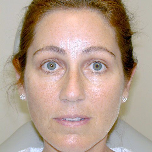 Browlift 12 After Photo 