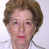 California Facelift 54