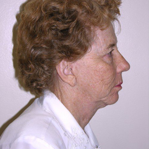 California Facelift 54 After Photo