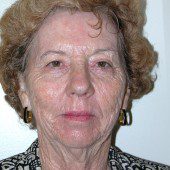 California Facelift 54