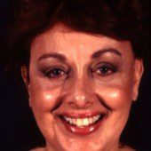 California Facelift 9