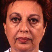 California Facelift 9