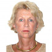 California Facelift 149