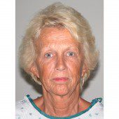 California Facelift 149