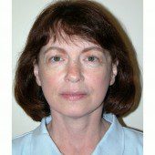 California Facelift 16