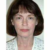 California Facelift 16