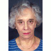 California Facelift 319