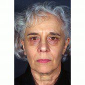 California Facelift 319