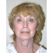 California Facelift 361