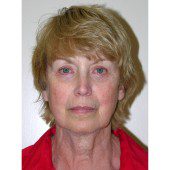 California Facelift 361