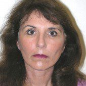 California Facelift 77