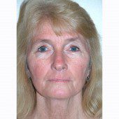 California Facelift 29