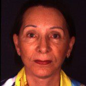 California Facelift 203