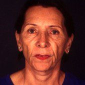 California Facelift 203