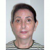 California Facelift 131