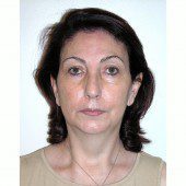 California Facelift 131