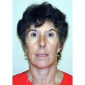 California Facelift 265