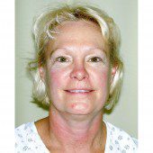 California Facelift 253