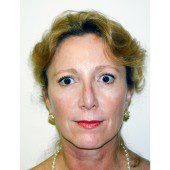 California Facelift 74