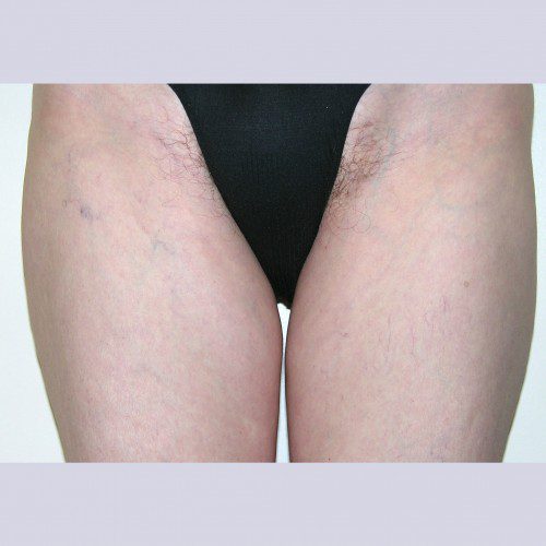 Liposuction 1 Before Photo 