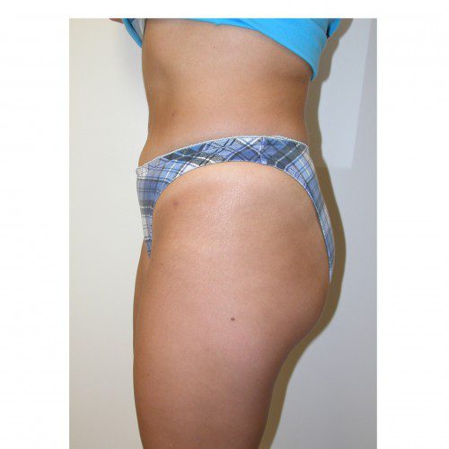 Liposuction 4 After Photo