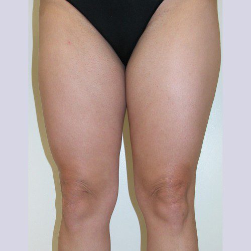 Liposuction 4 Before Photo 