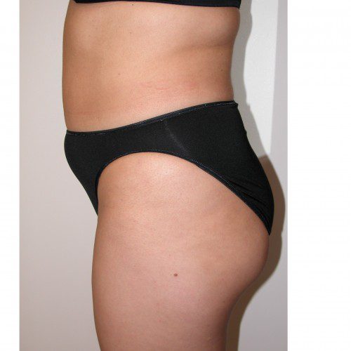 Liposuction 4 Before Photo