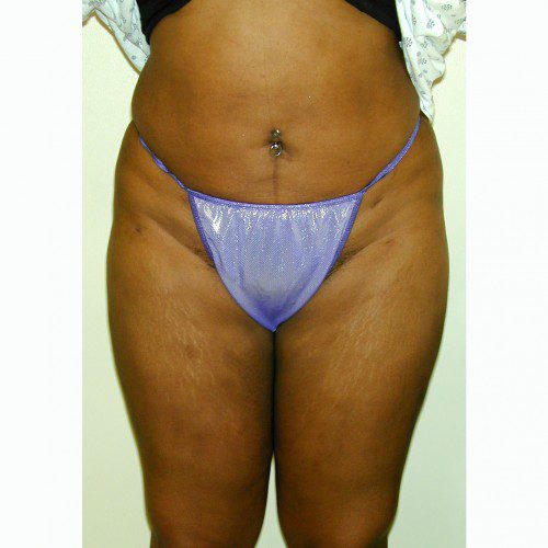 Liposuction 5 After Photo 