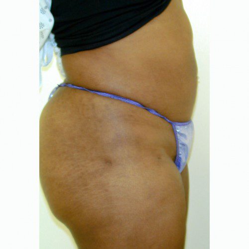 Liposuction 5 After Photo