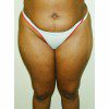 Liposuction 5 Before Photo Thumbnail