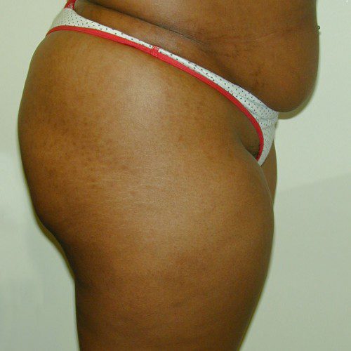 Liposuction 5 Before Photo