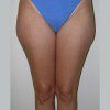 Liposuction 6 Before Photo Thumbnail