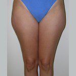 Liposuction 6 Before Photo - 5