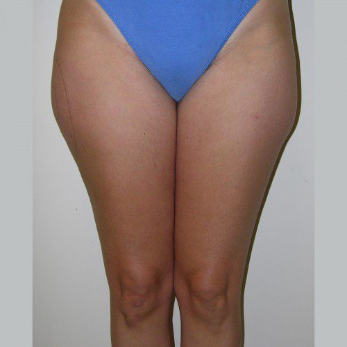 Liposuction 6 Before Photo 