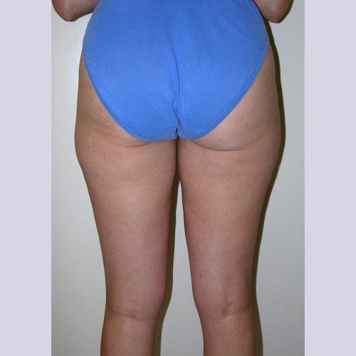 Liposuction 6 Before Photo