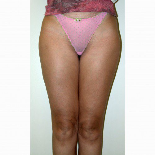Liposuction 7 After Photo 