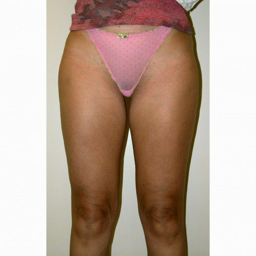 Liposuction 7 After Photo