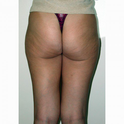 Liposuction 7 Before Photo