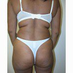 Liposuction 8 Before Photo - 3