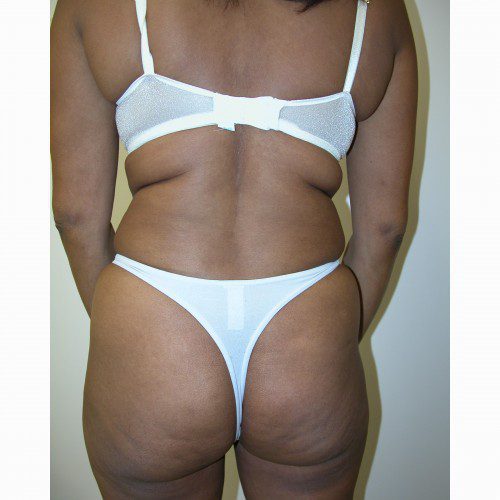 Liposuction 8 Before Photo 