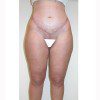 Liposuction 10 After Photo Thumbnail