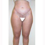 Liposuction 10 After Photo - 6