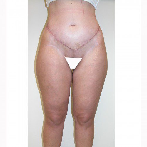 Liposuction 10 After Photo 