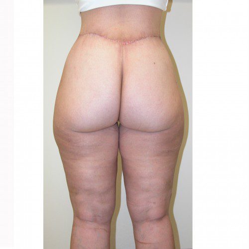 Liposuction 10 After Photo