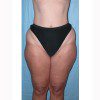 Liposuction 10 Before Photo Thumbnail